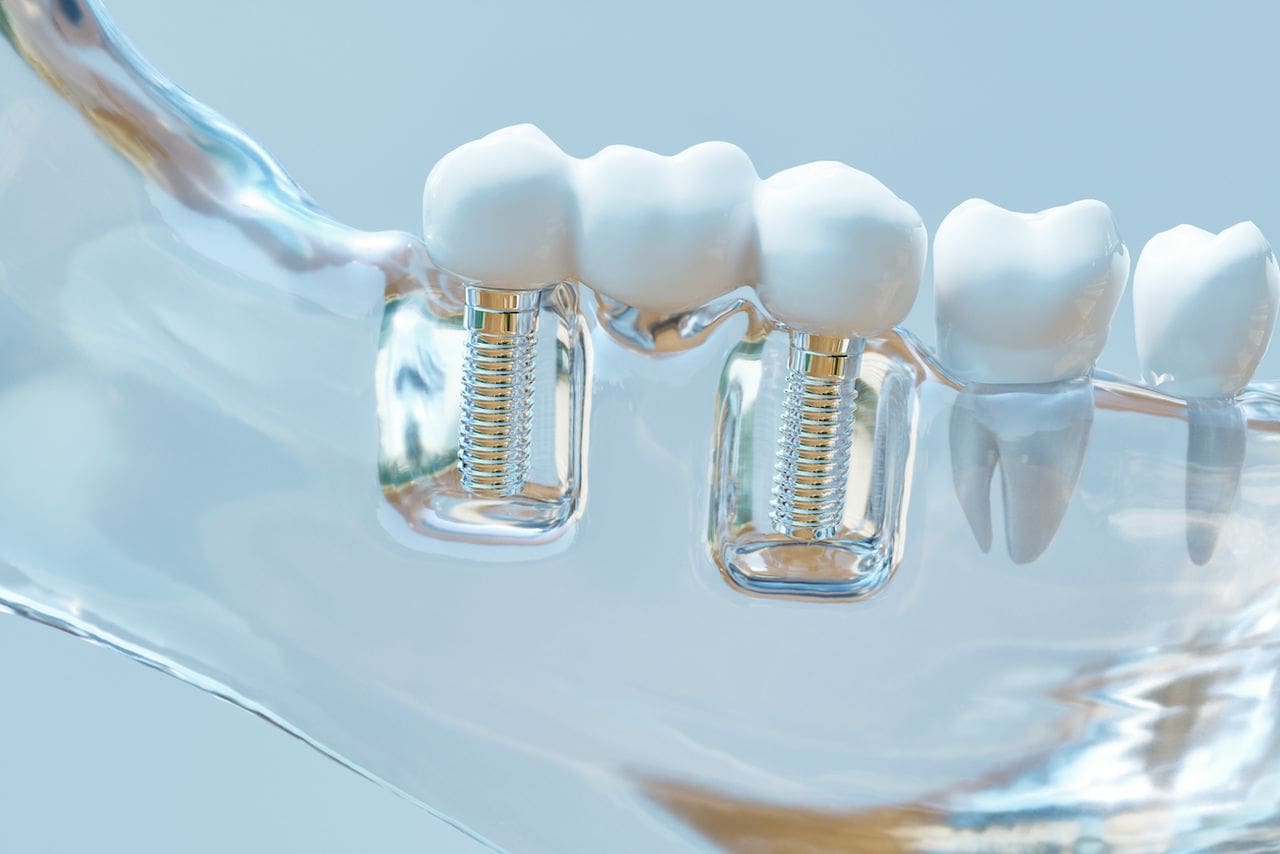 Dental Bridge in Skokie and Chicago, IL
