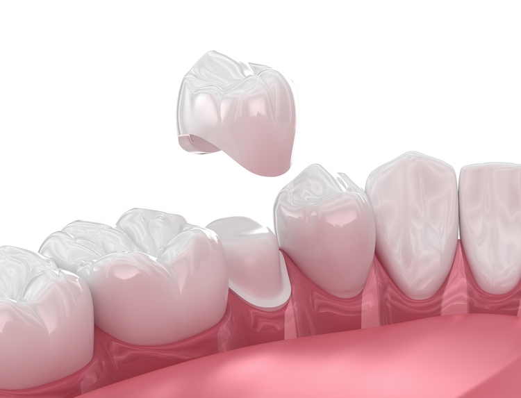 Understanding the situations that call for a dental crown can help you make an informed decision about your oral health.