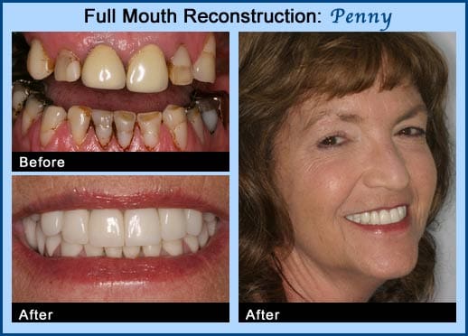 Happy patient after a full mouth reconstruction with restorative dentistry