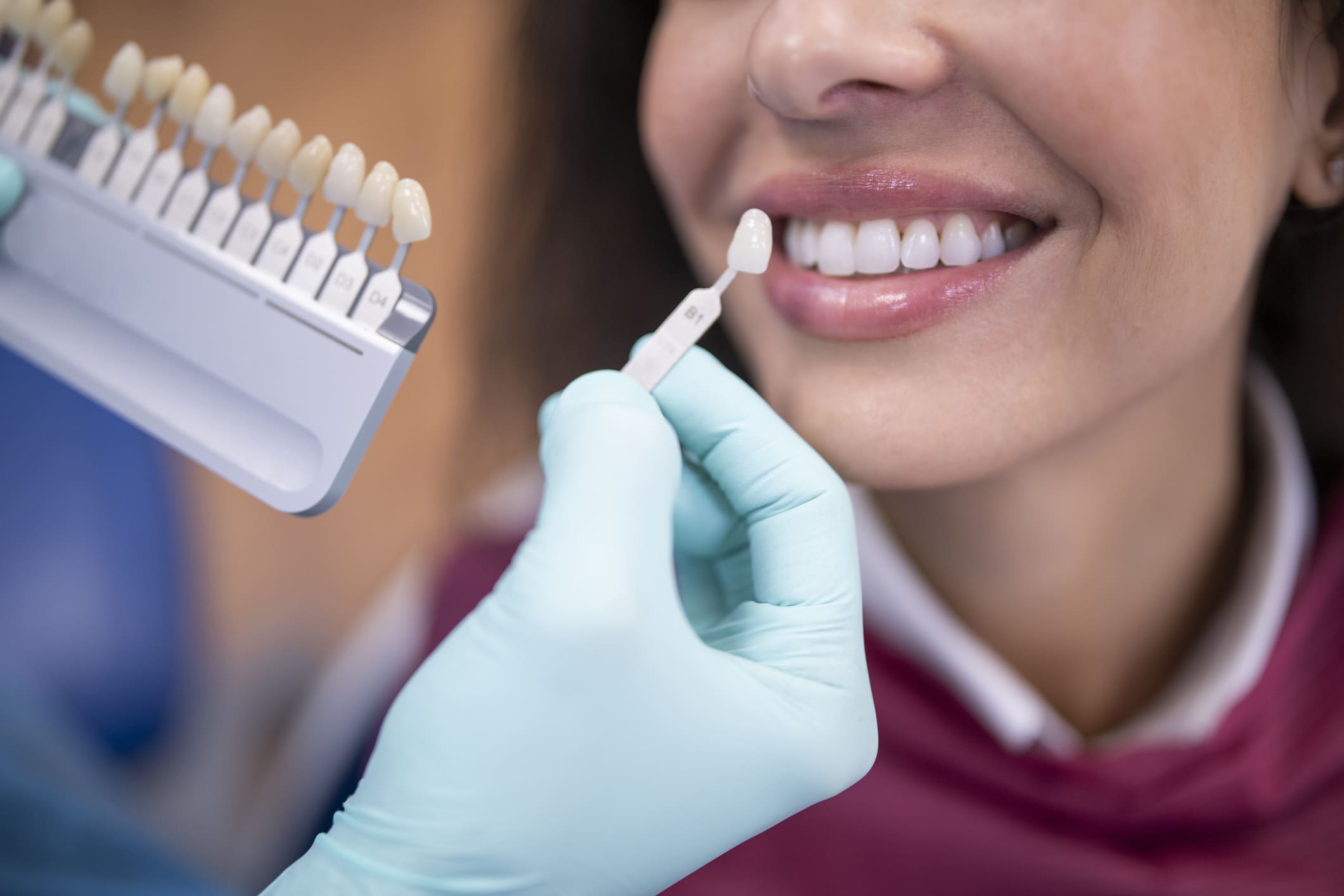 Porcelain Veneers in Chicago, IL