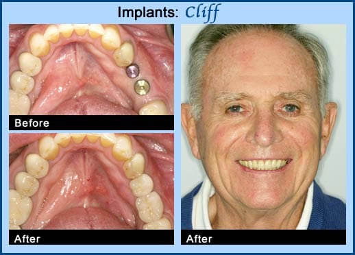 Happy patient after restoring oral health with dental implants in Chicago IL
