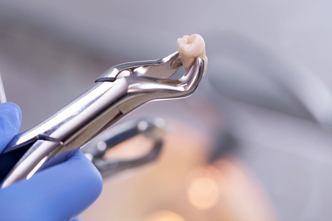 Tooth Extractions in Chicago and Skokie, IL