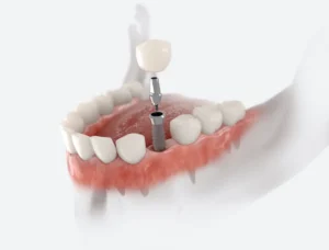 Why Choose Dental Implants for Tooth Loss in Skokie, IL