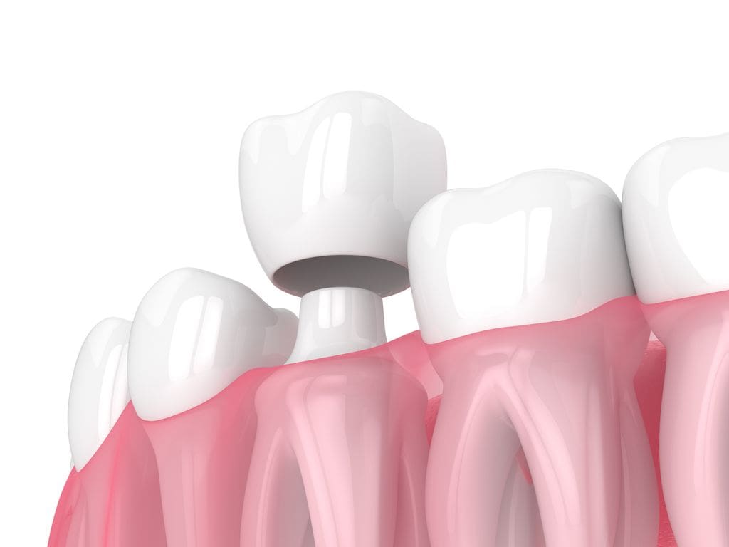 Dental Crown in Skokie and Chicago, IL
